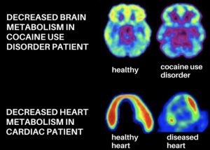 Brain and heart scans demonstrate decreased metabolism in a patient with cocaine use disorder. (Image courtesy of Dr. Woods)